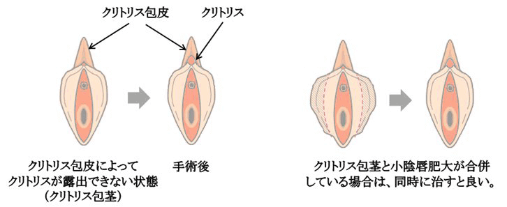 クリトリスの包茎治療をお考えなら女性医師が担当（完全個室・プライバシー保護）銀座みゆき通り美容外科・美容皮膚科・婦人科形成  ｜美容整形｜東京・中央区・銀座｜大阪・梅田