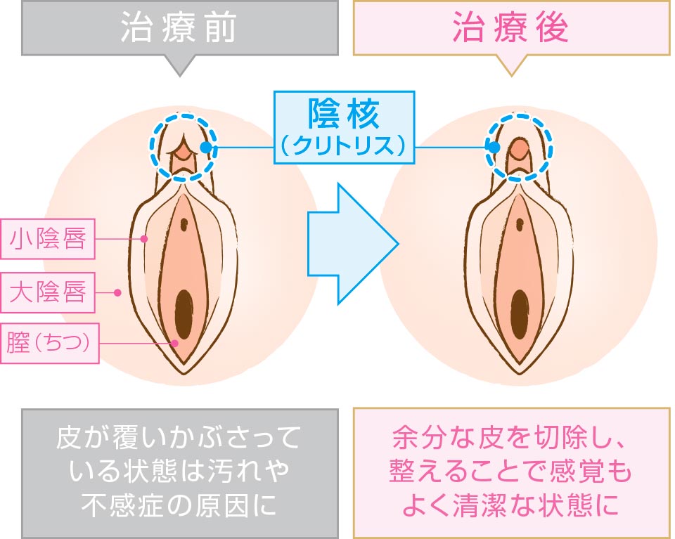 クリトリス包茎 | 婦人科形成なら城本クリニック