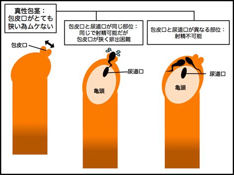 クリトリス包茎縮小手術をすることで感度が上がる理由について