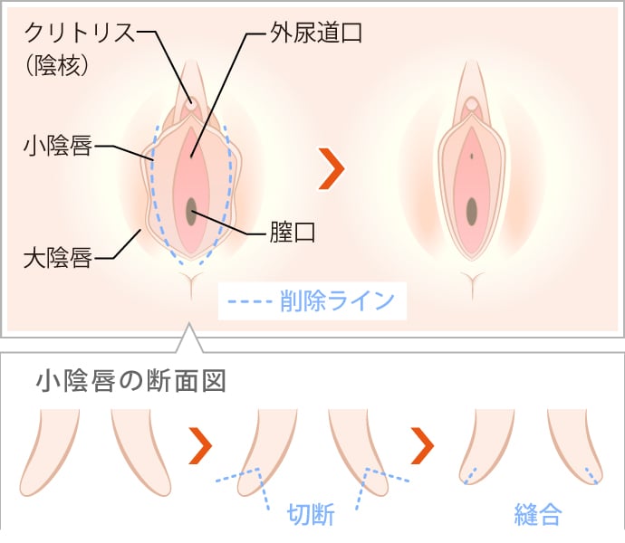 クリトリス包茎だと感じづらい？皮の剥き方 - 夜の保健室