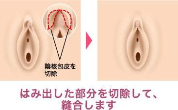 クリトリス包茎で叶える快適なインティメイトケア | ガーデンクリニック