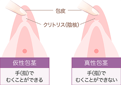 クリトリス（陰核）包茎手術 | 婦人科形成 | 美容整形はTCB東京中央美容外科