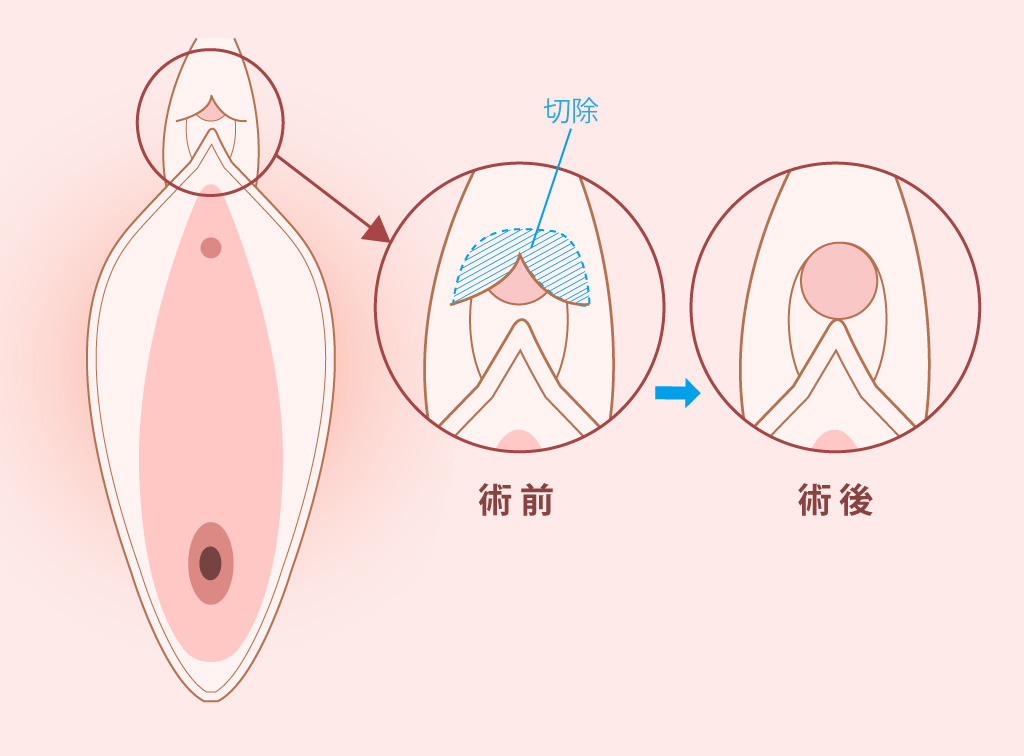 小陰唇縮小術 | 大阪のツツイ美容外科・美容皮膚科（心斎橋）