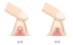 クリトリス包茎だと感じづらい？皮の剥き方 - 夜の保健室