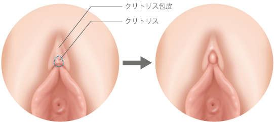 小陰唇縮小術・副皮切除・クリトリス包茎切除術｜京都・滋賀の大西皮フ科形成外科医院【大津石山,四条烏丸】